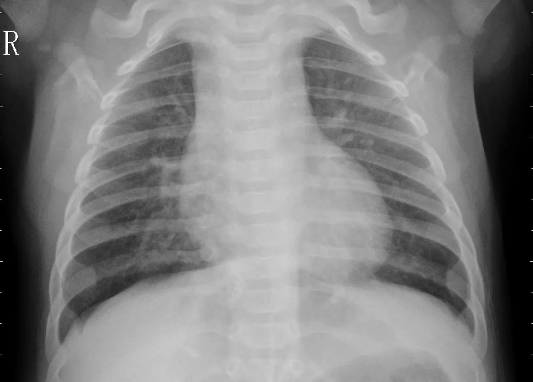 Pneumonia Prediction in Chest X-Ray Images — banner