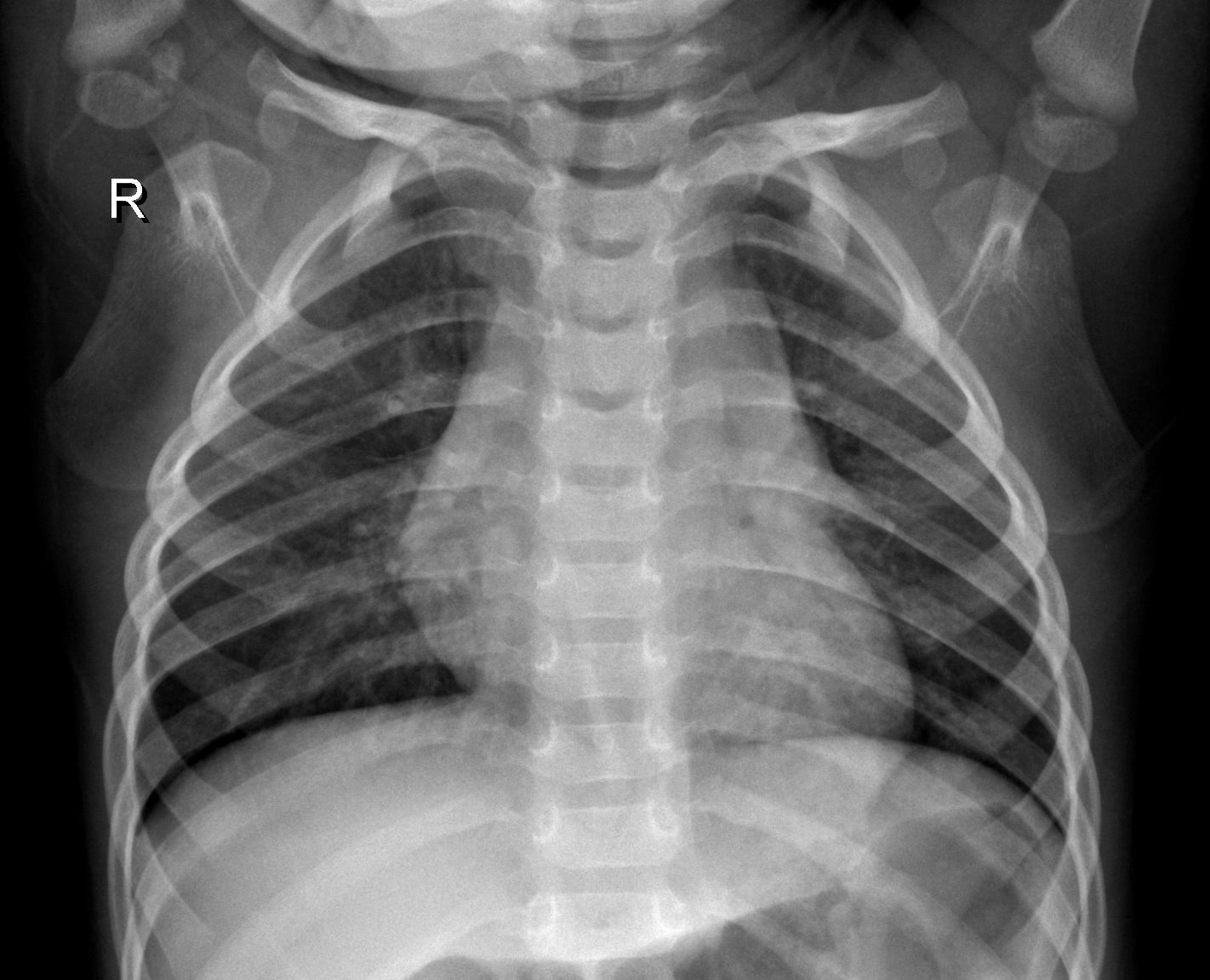 Pneumonia Prediction in Chest X-Ray Images — screenshot 2
