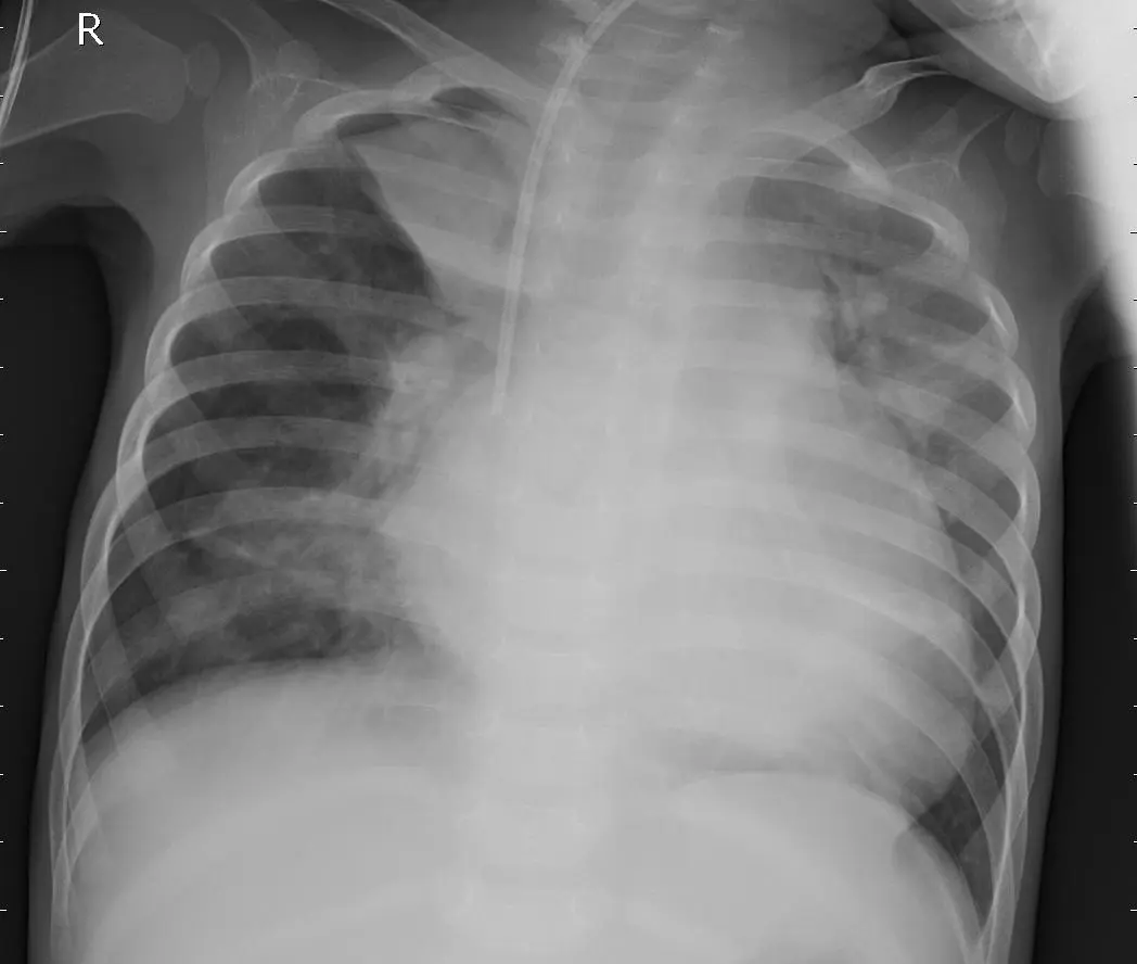 Pneumonia Prediction in Chest X-Ray Images — screenshot 3